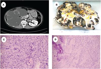 Case report: Sarcomatoid renal cell carcinoma masquerading as hydronephrosis
